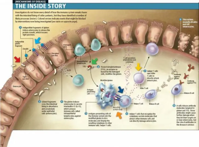 Infographic depicting the mechanisms of Celiac Disease