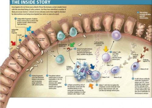 Infographic depicting the mechanisms of Celiac Disease